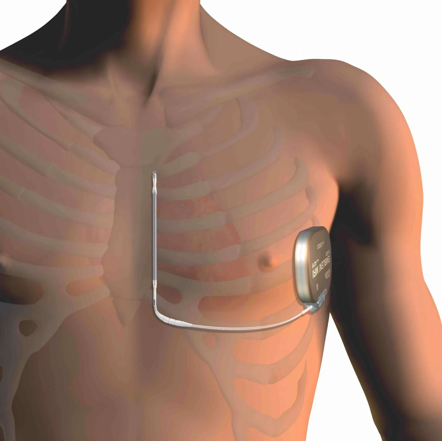 تعبیه باتری سابکوتانئوس (S-ICD)؛ از خدمات دکتر نرگس عزتپناه